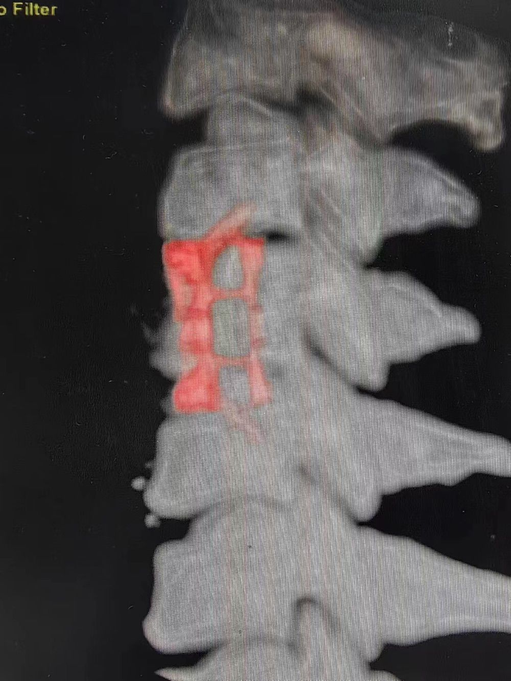 雙腿無力走路好似“踩棉花” 3D打印技術助她邁出穩(wěn)健步伐